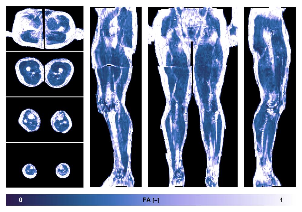 IVIM corrected whole leg muscle fractional anisotropy obtained from diffusion tensor imaging.